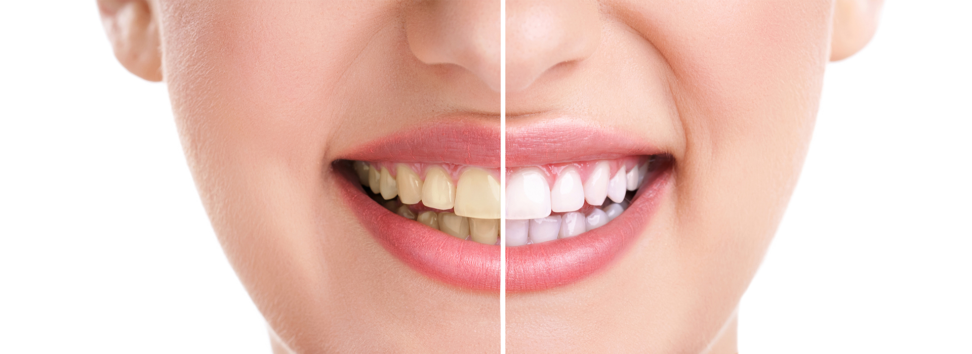 Village Dental | Teeth Whitening, Preventative Program and Dental Cleanings