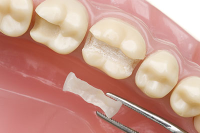 Village Dental | Crowns  amp  Caps, Dental Bridges and Veneers