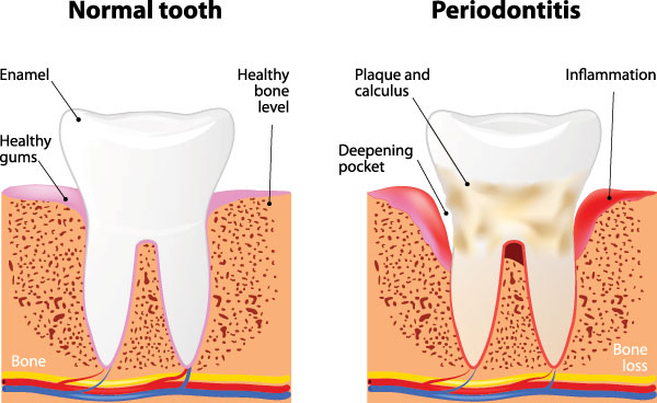 Village Dental | Nitrous Oxide, Extractions and Oral Exams