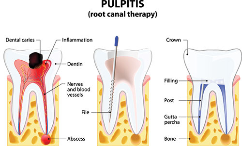 Village Dental | Extractions, Implant Dentistry and Veneers