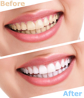 Village Dental | Dental Fillings, Teeth Whitening and Cosmetic Dentistry